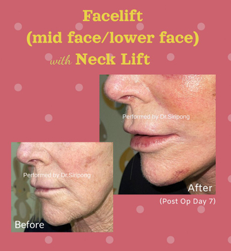 Slider image (3) Dr. Siripong Plastic Surgery in Thailand